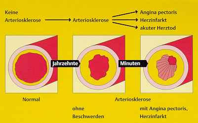 EntstehungArteriosklerose