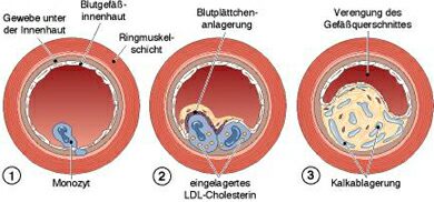 entwicklung_arteriosklerose